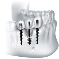 ⁠Базальная имплантация зубов