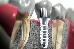 ⁠Имплантация зубов без разреза