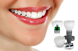 Имплантация зубов - лучший метод современного протезирования.