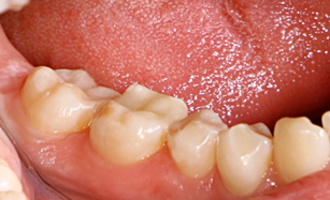 Зубные вкладки- это частичное  протезирование с использованием манипуляции  художественной реставрации зубов. Используются при значительном  разрушении части зуба и являются промежуточным вариантом  между пломбой и коронкой.