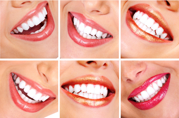 ⁠Профессиональное отбеливание зубов производится исключительно специалистом в клинике. Этим методом Вы легко можете осветлить эмаль своих зубов на один-два тона!