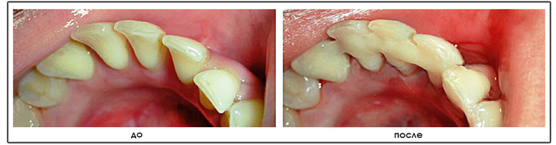При обращении к врачу, назначается комплексная терапия, в том числе шинирование подвижных зубов