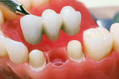 ⁠Зубные мосты (мостовидные зубные протезы)