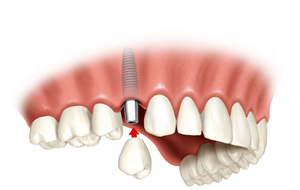 ⁠Имплантация зубов - это самый эффективный и наиболее  безопасный способ восстановления утраченных зубов  в  современной стоматологии.