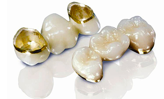 Зубные коронки- ⁠это специальные колпачки на зубы,  замещающие частично или полностью разрушенную часть  зуба.