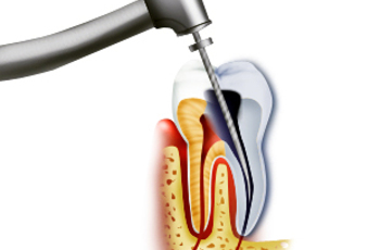 ⁠Лечение каналов зуба (эндодонтическое лечение) - по праву можно назвать основополагающим во всей терапевтической стоматологии.