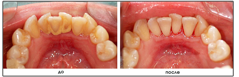 Заказав услугу гигиенической чистки зубов, в особо сложных и запущенных случаях лечение гингивита начинается с удаления зубного налета и камней.